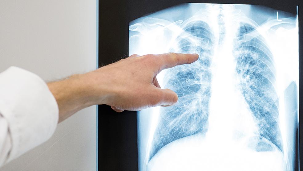 Ein Arzt zeigt das Röntgenbild einer Lunge.  © Symbolfoto: Stein (dpa)